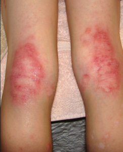Natural Remedies for Eczema