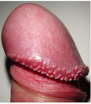 How To Get Rid of Pearly Penile Papules On Shaft