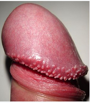 Pearly Penile Papules