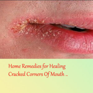 Cracked Corners Of Mouth Treatment