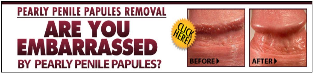 Pearly Penile Papules Removal By Josh Marvin Reviews - Is It A Scam? 
