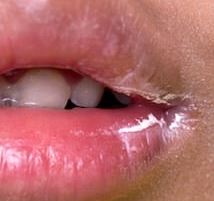 What Causes Cracks In Corner of Mouth