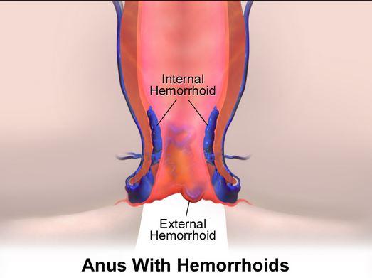 Will a Thrombosed Hemorrhoid Go Away Without Surgery?