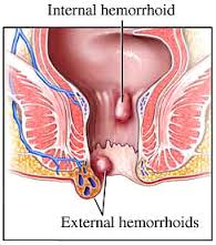External Hemorrhoid Treatment without Surgery