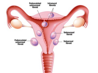 How To Get Rid Of Uterine Fibroids Without Surgery Naturally?