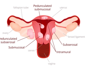Herbal Remedies For Fibroids in Uterus