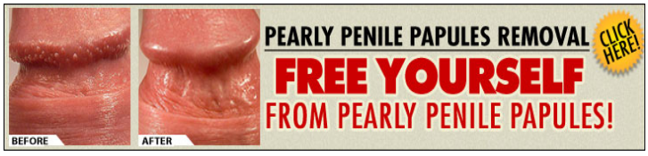 Pearly Penile Papules Treatment with Alpha Hydroxyl Acid (AHA). 