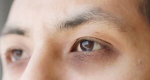 Dark Circle Under Eye